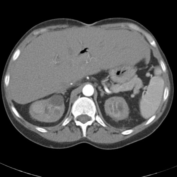 File:Biliary necrosis - liver transplant (Radiopaedia 21876-21845 A 16).jpg