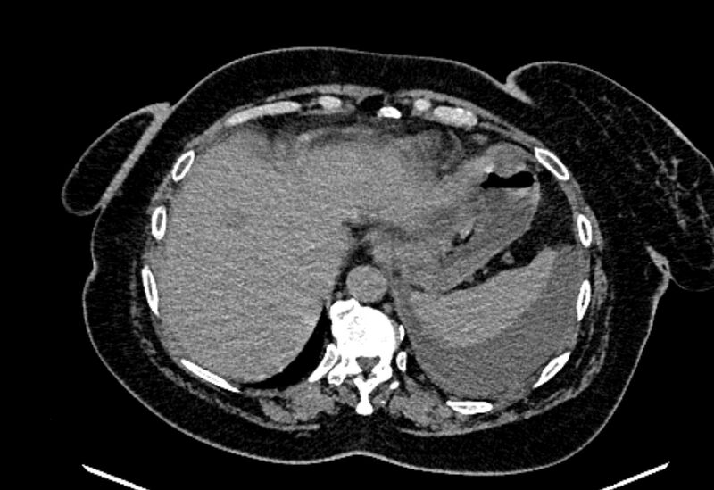 File:Biliary pancreatitis (Radiopaedia 72289-82823 Axial non-contrast 54).jpg