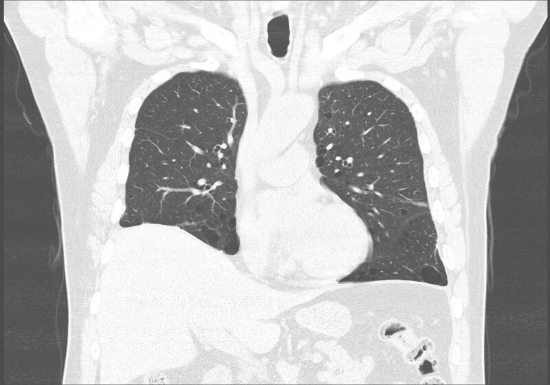 File:Birt-Hogg-Dubé syndrome (Radiopaedia 52578-58491 Coronal lung window 22).jpg