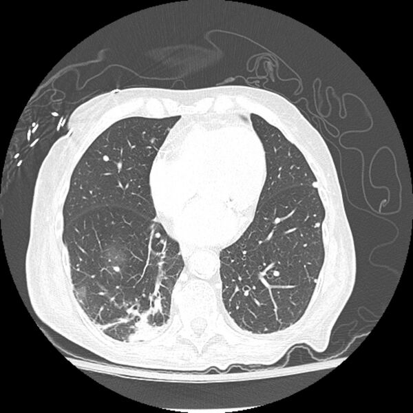 File:Bladder cancer metastases (Radiopaedia 9824-10409 Axial lung window 4).jpg