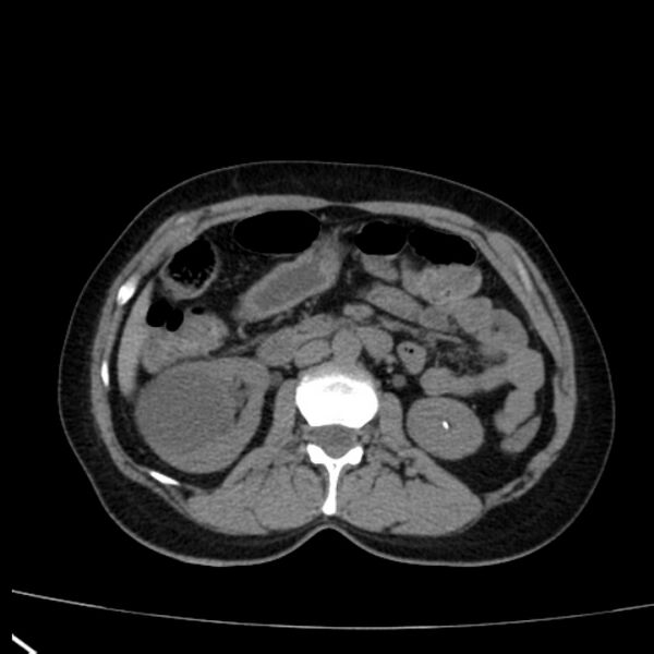 File:Bosniak renal cyst - type I (Radiopaedia 27479-27675 Axial non-contrast 39).jpg