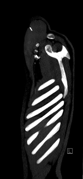 File:Brachiocephalic trunk pseudoaneurysm (Radiopaedia 70978-81191 C 7).jpg