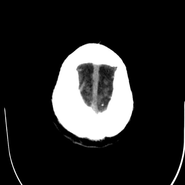 File:Brain Pantopaque remnants (Radiopaedia 78403-91048 Axial non-contrast 85).jpg