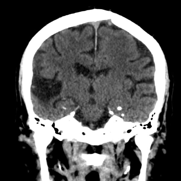 File:Brain Pantopaque remnants (Radiopaedia 78403-91048 Coronal non-contrast 38).jpg