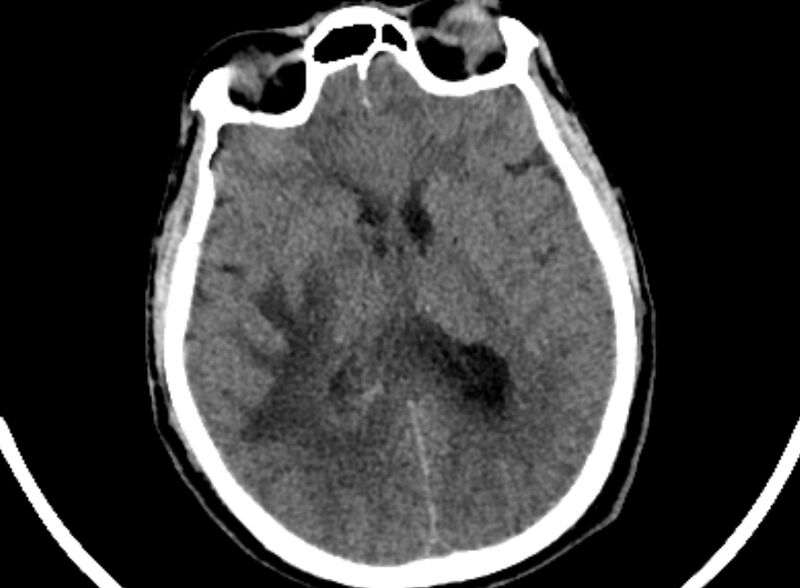File:Brain abscess complicated by intraventricular rupture and ventriculitis (Radiopaedia 82434-96575 Axial non-contrast 48).jpg