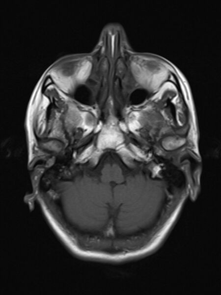 File:Brain metastasis as initial presentation of non-small cell lung cancer (Radiopaedia 65122-74126 Axial T1 5).jpg