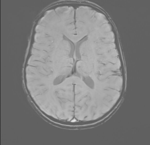 File:Brainstem glioma (Radiopaedia 70548-80674 Axial SWI 36).jpg