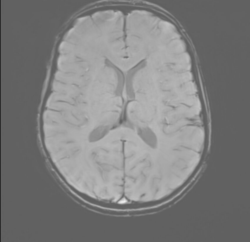 Brainstem glioma (Radiopaedia 70548-80674 Axial SWI 36).jpg