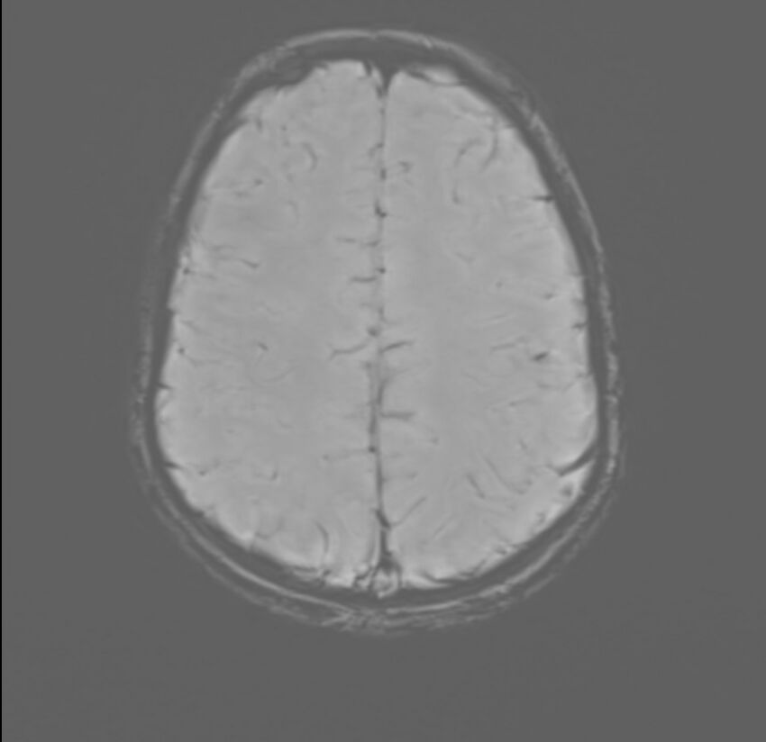 Brainstem glioma (Radiopaedia 70548-80674 Axial SWI 49).jpg