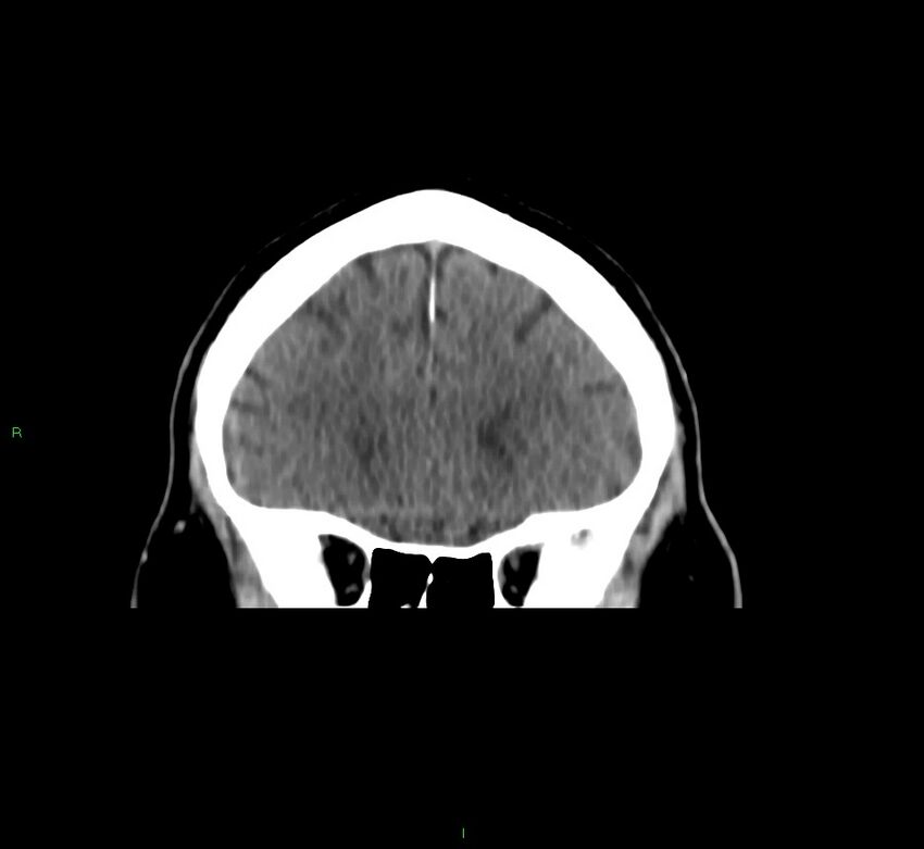 Brainstem hemorrhage (Radiopaedia 58794-66028 Coronal non-contrast 48).jpg
