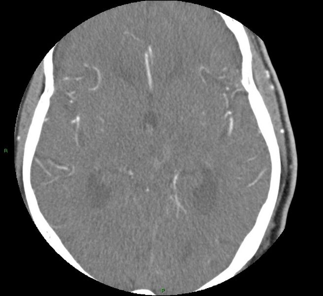 File:Brainstem hemorrhage (Radiopaedia 58794-66028 D 91).jpg