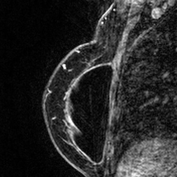 File:Breast implants - MRI (Radiopaedia 26864-27035 Sagittal T2 89).jpg