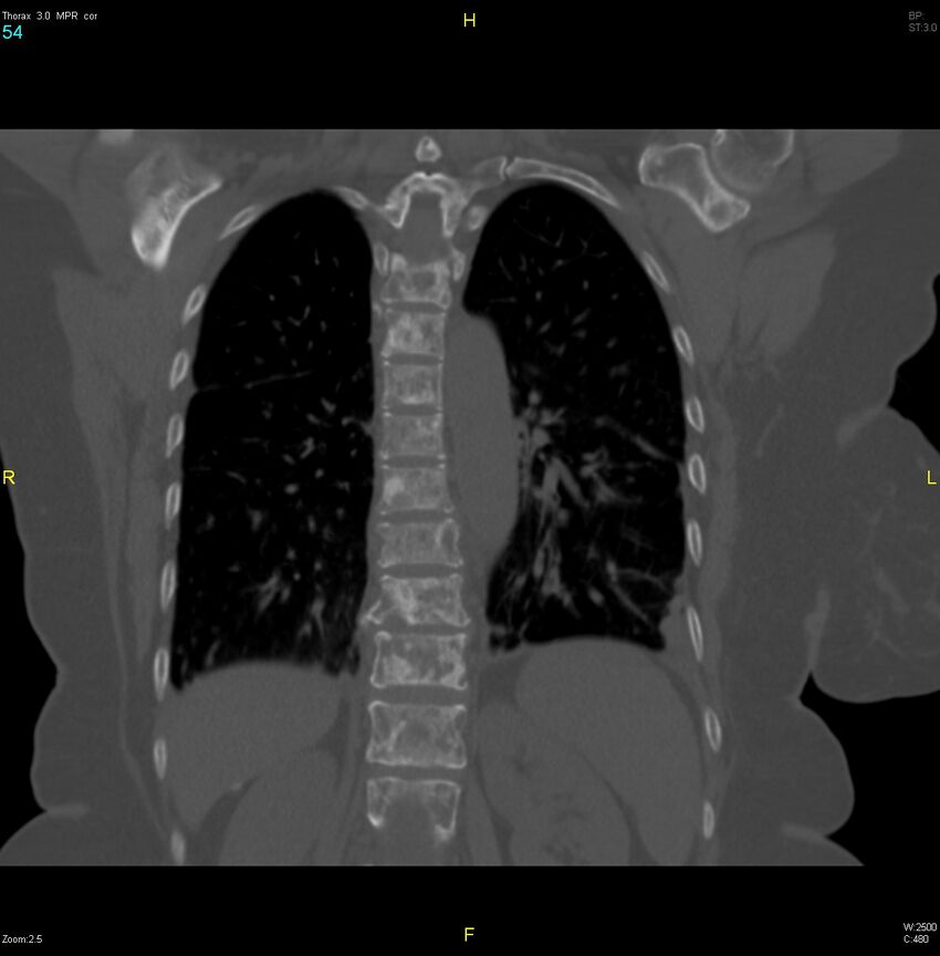 Breast primary with lung and bone metastases (Radiopaedia 40620-43228 bone window 54).jpg