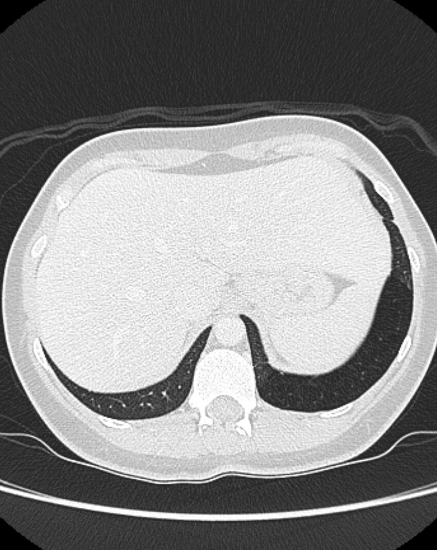 Bronchial atresia (Radiopaedia 50007-55297 Axial lung window 102).jpg