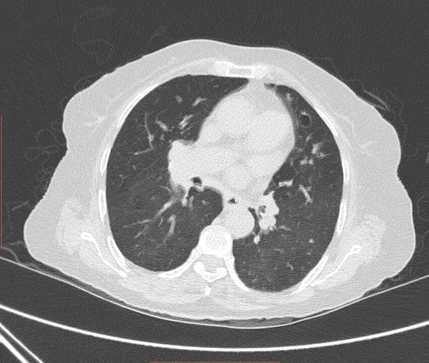 Bronchiectasis (Radiopaedia 72693-83293 Axial lung window 66).jpg