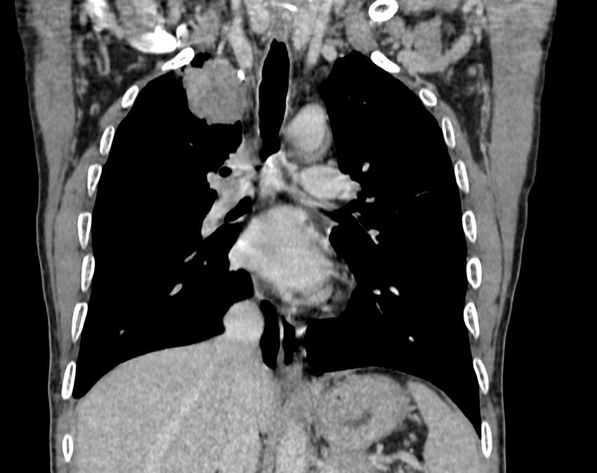 Bronchogenic carcinoma with superior vena cava syndrome (Radiopaedia 36497-38054 Coronal C+ delayed 46).jpg