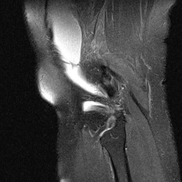 File:Bucket handle tear - medial meniscus (Radiopaedia 79028-91942 Sagittal PD fat sat 2).jpg