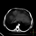 Budd-Chiari syndrome (Radiopaedia 23072-23103 C+ arterial phase 1).jpg