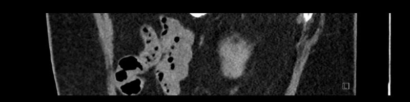 File:Buried bumper syndrome - gastrostomy tube (Radiopaedia 63843-72575 Sagittal Inject 23).jpg