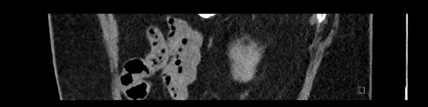 Buried bumper syndrome - gastrostomy tube (Radiopaedia 63843-72575 Sagittal Inject 23).jpg