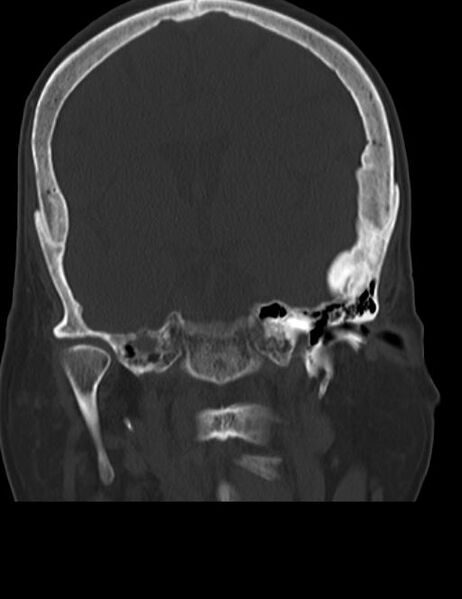 File:Burnt-out meningioma (Radiopaedia 51557-57337 Coronal bone window 26).jpg
