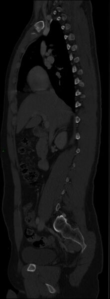 File:Burst fracture (Radiopaedia 83168-97542 Sagittal bone window 57).jpg