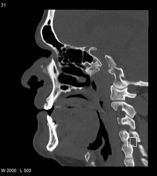 File:Calcification of the transverse band of the cruciform ligament (Radiopaedia 53063-59025 Sagittal bone window 8).jpg