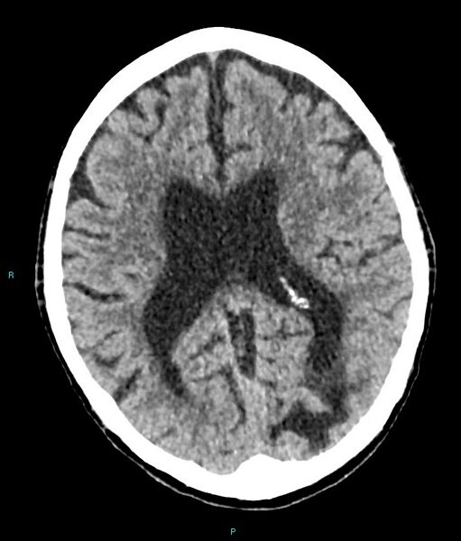 File:Calcified cerebral emboli from left ventricular thrombus (Radiopaedia 84420-99758 Axial non-contrast 42).jpg