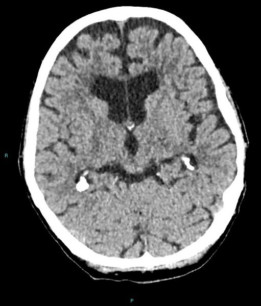 File:Calcified cerebral emboli from left ventricular thrombus (Radiopaedia 84420-99758 Axial non-contrast 54).jpg