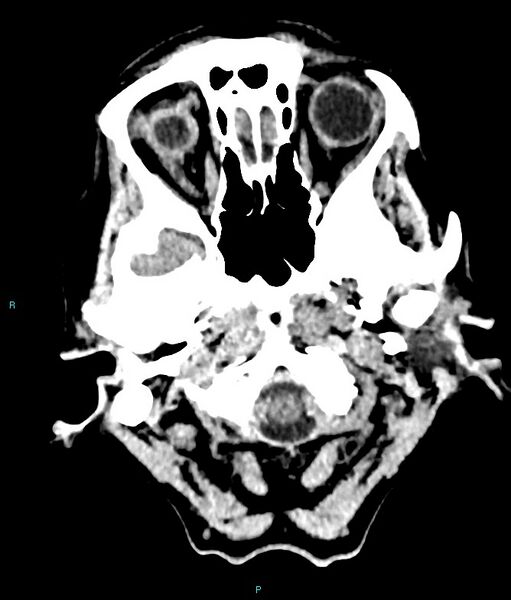 File:Calcified cerebral emboli from left ventricular thrombus (Radiopaedia 84420-99758 Axial non-contrast 82).jpg