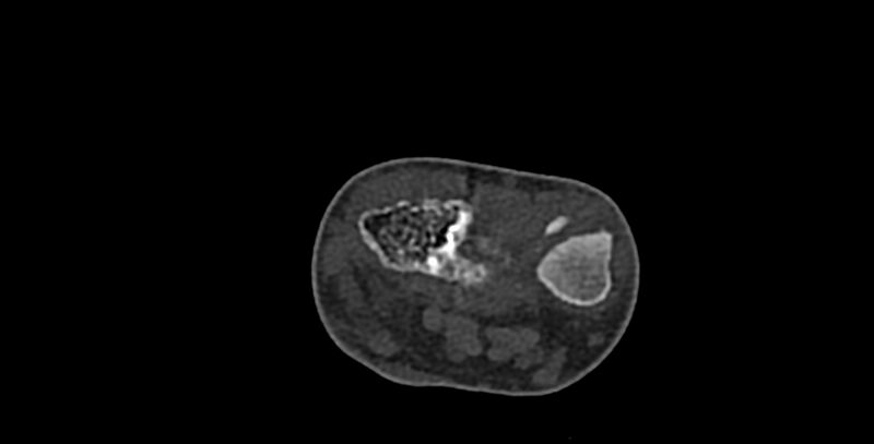 File:Calcifying aponeurotic fibroma (Radiopaedia 88423-105064 Axial bone window 29).jpg