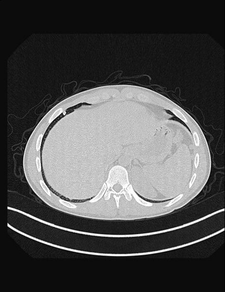 File:Calcifying pulmonary metastases (Radiopaedia 33359-34396 Axial lung window 56).jpg
