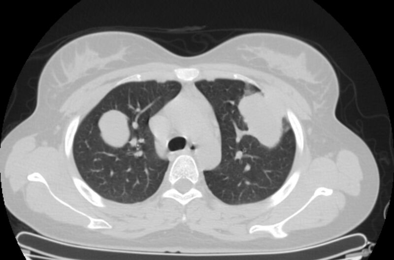 File:Cannonball metastases - uterine choriocarcinoma (Radiopaedia 70137-80173 Axial lung window 21).jpg