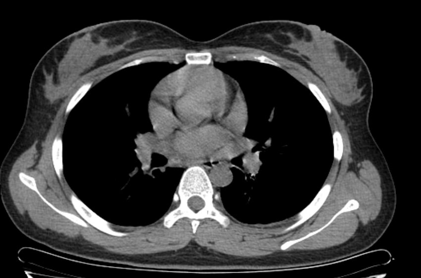 Cannonball metastases - uterine choriocarcinoma (Radiopaedia 70137-80173 Axial non-contrast 53).jpg