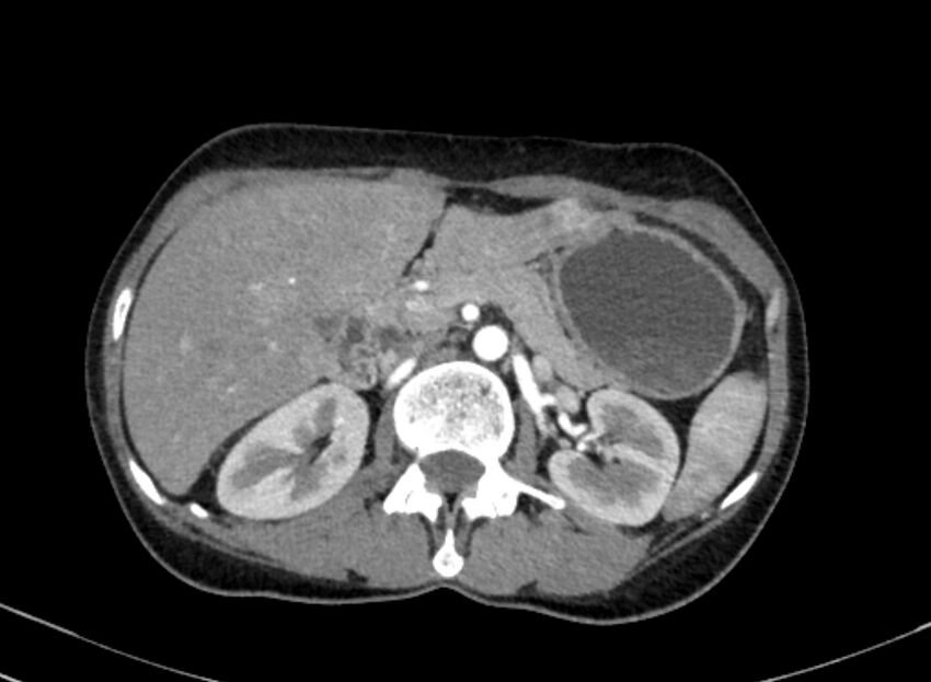 Cannonball metastases from breast cancer (Radiopaedia 91024-108569 A 132).jpg