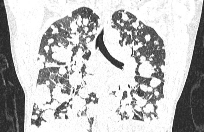 File:Cannonball metastases from breast cancer (Radiopaedia 91024-108569 Coronal lung window 86).jpg