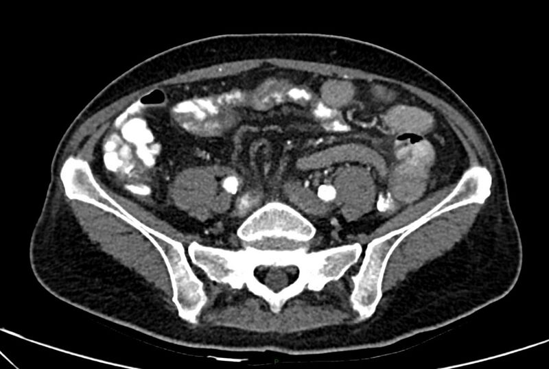File:Carcinoid mesenteric tumor complicated by chylous ascites (Radiopaedia 76312-88926 A 50).jpg