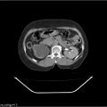 Carcinoma cervix- recurrence (Radiopaedia 34702-36137 B 71).jpg