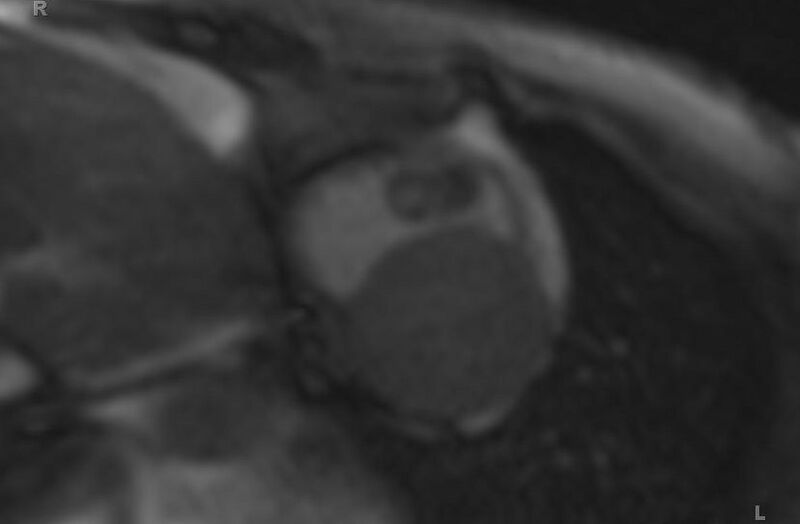 File:Cardiac hemangioma (Radiopaedia 31709-32631 Short axis 74).jpg