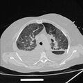 Cardiogenic pulmonary edema (Radiopaedia 29213-29609 Axial lung window 28).jpg