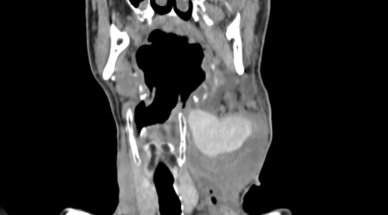 File:Carotid artery pseudoaneurysm (Radiopaedia 84030-99259 D 36).jpg