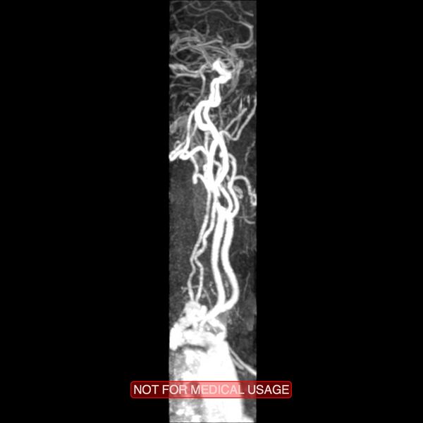 File:Carotid artery stenosis (Radiopaedia 28786-29087 3D MRA 1).jpg