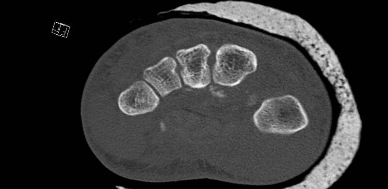 File:Carpal fractures (smart watch impaction) (Radiopaedia 55844-62430 Axial bone window 43).jpg