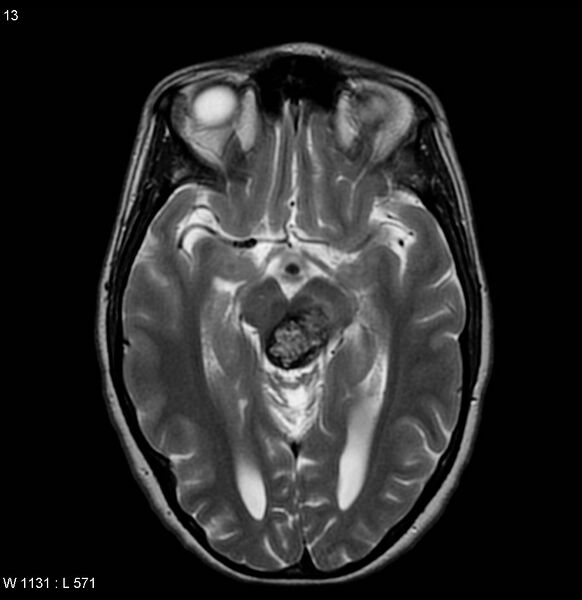 File:Cavernous malformation of the midbrain (Radiopaedia 7791-8615 Axial T2 2).jpg