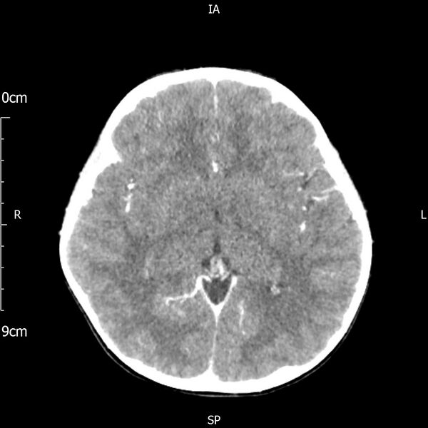 File:Cavernous sinus thrombosis (Radiopaedia 79414-92510 Axial Brain 102).jpg