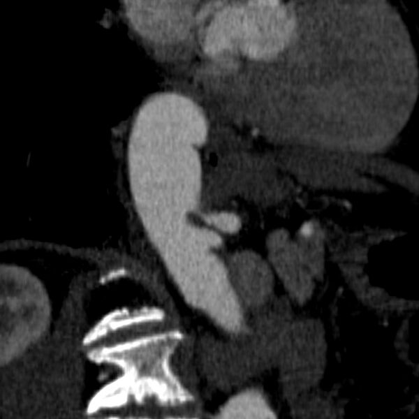 File:Celiac artery aneurysm (Radiopaedia 21574-21525 B 2).JPEG
