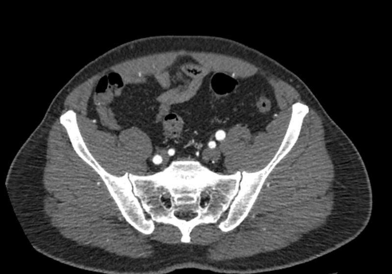 File:Celiac artery dissection (Radiopaedia 52194-58080 A 91).jpg