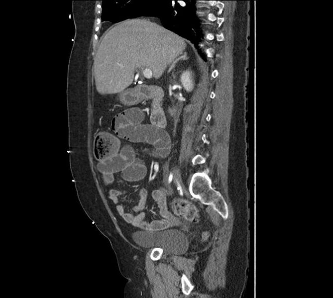File:Celiac artery severe stenosis and dissection (Radiopaedia 44128-47842 A 26).jpg