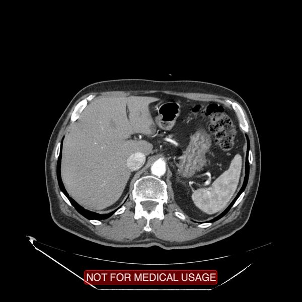 File:Celiac trunk variant anatomy - gastrohepatic trunk and splenic artery (Radiopaedia 38815-40995 A 9).jpg