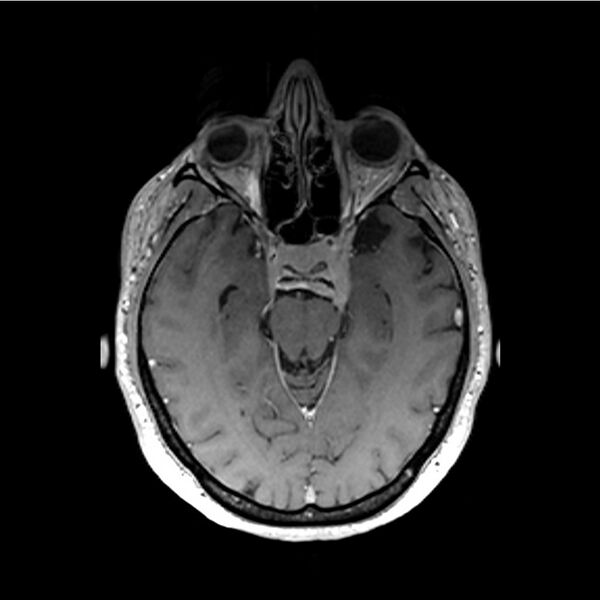 File:Central base of skull meningioma (Radiopaedia 53531-59549 Axial T1 C+ 21).jpg